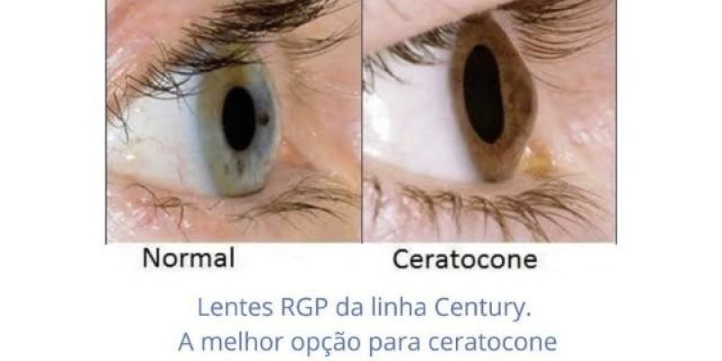 O que são lentes RGP?